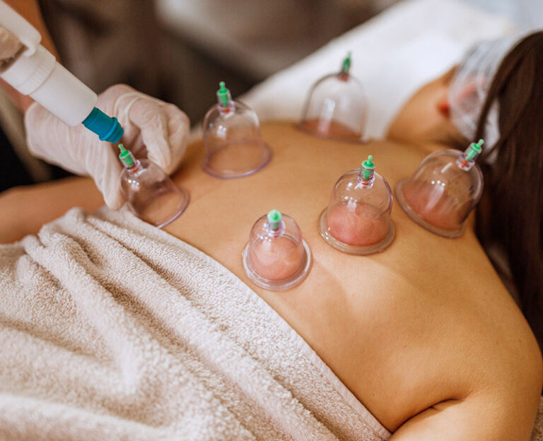 16554-cupping-therapy